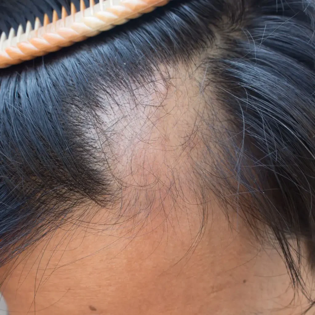 free consultation for hair loss