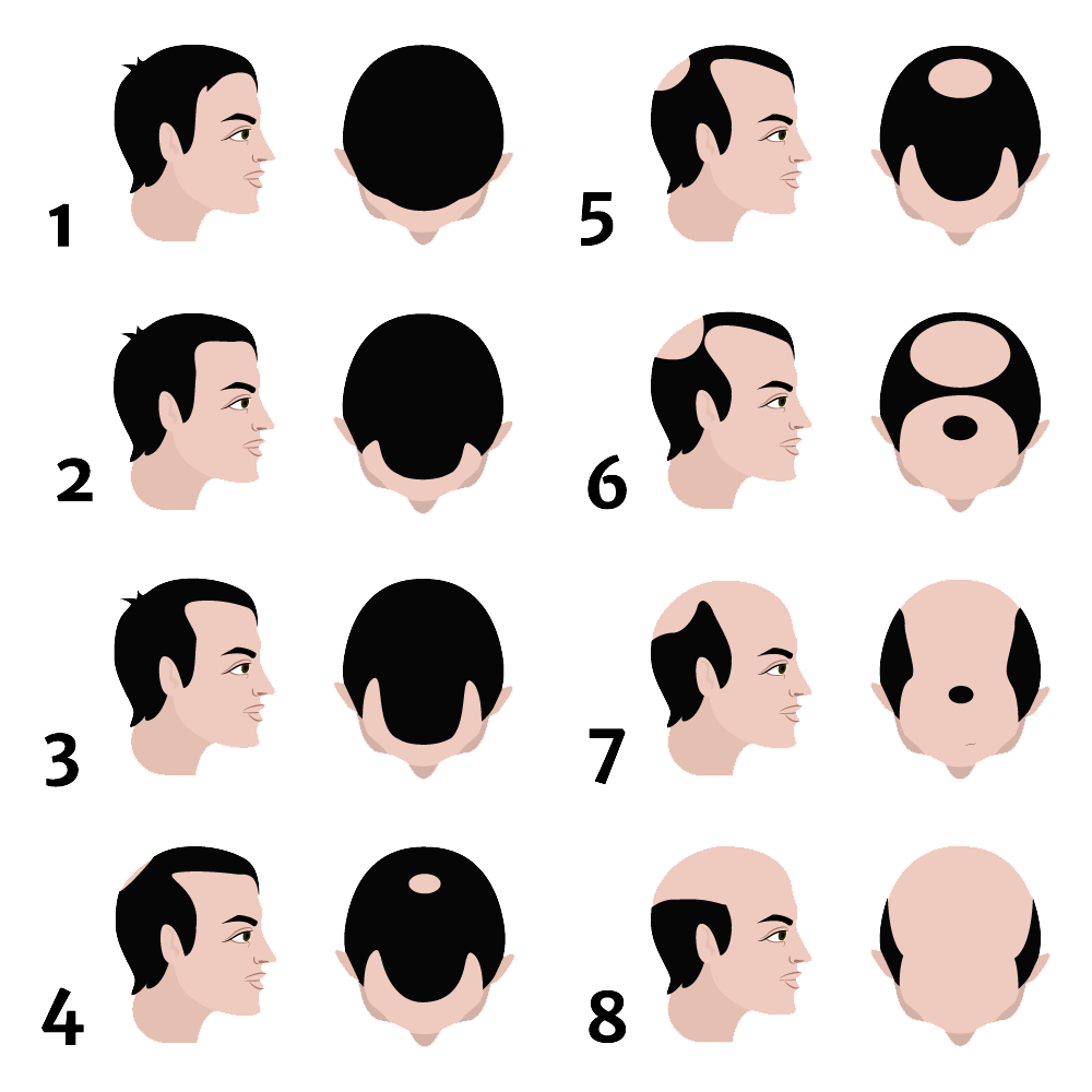 norwood scale